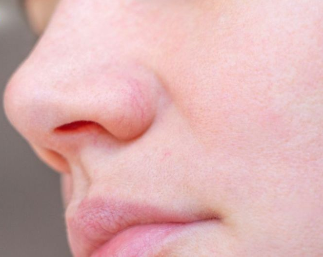Da mỏng lộ mao mạch: Chỉ dẫn cách chăm sóc đúng để da khỏe đẹp hơn