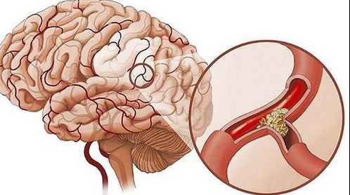 Huyết hư ứ trệ thường gây ra những bệnh nguy hiểm gì?
