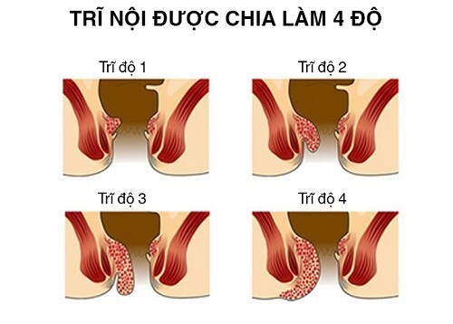 4 cấp độ bệnh trĩ – Cách nhận biết bạn đang ở giai đoạn nào