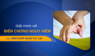 Giật mình với biến chứng nguy hiểm của viêm khớp ngón tay cái