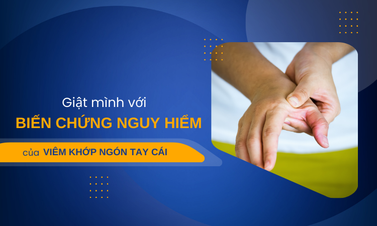 Giật mình với biến chứng nguy hiểm của viêm khớp ngón tay cái