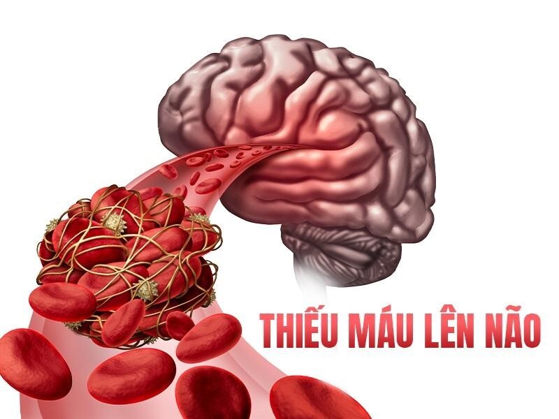Bạn có chắc mình không bị thiếu máu lên não? 7 dấu hiệu dễ bỏ qua!
