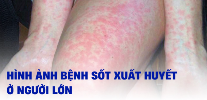 Sốt xuất huyết dấu hiệu nào cảnh báo nguy hiểm cần nhập viện khẩn cấp