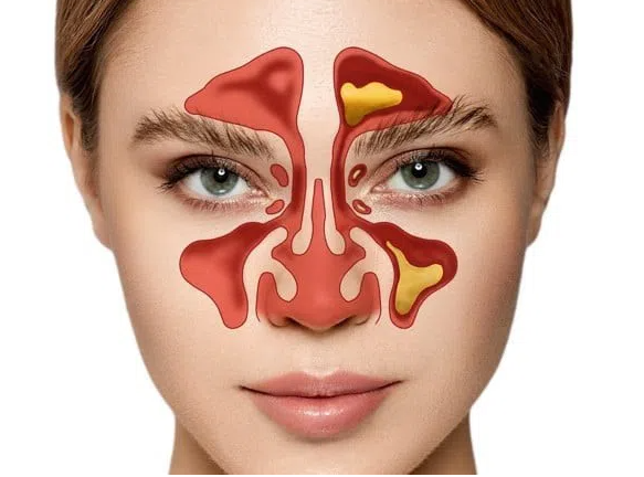 Lưu ngay những cách trị ngạt mũi cho người bị viêm xoang mãn tính
