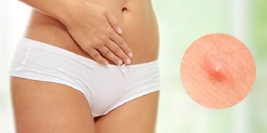 Vùng kín nổi mụn: Nguyên nhân và cách xử lý an toàn