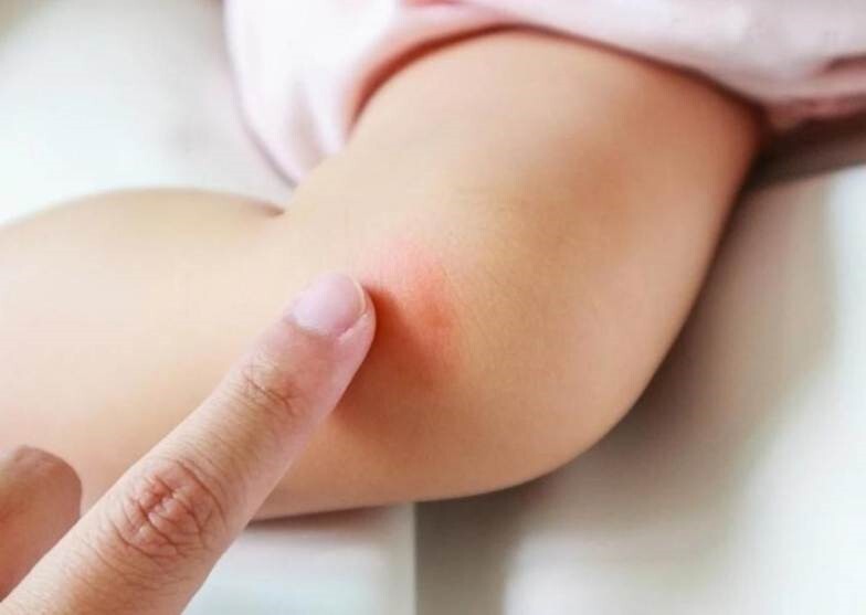 Chống muỗi cho bé: Việc làm cần thiết để ngăn ngừa bệnh truyền nhiễm