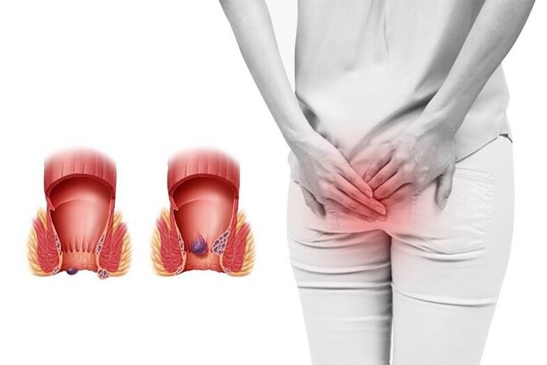 Bệnh trĩ ngoại có nguy hiểm không? Biện pháp cải thiện và phòng ngừa 