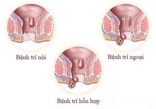 Bệnh trĩ ngoại có nguy hiểm không? Biện pháp cải thiện và phòng ngừa 