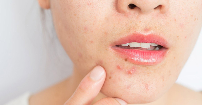 Uống kẽm trị mụn: Sự thật hay chỉ là lời đồn?
