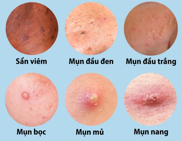 Uống kẽm trị mụn: Sự thật hay chỉ là lời đồn?