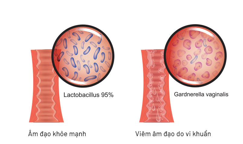 5 bệnh phụ khoa thường gặp khi khí hư có mùi hôi