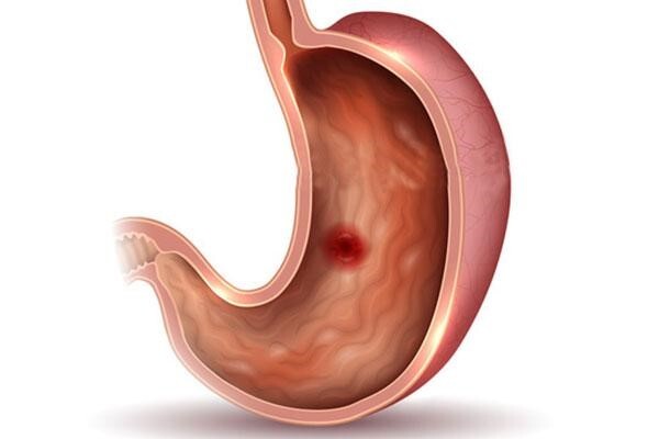 Giải đáp nhanh: Viêm loét dạ dày có nguy hiểm không?