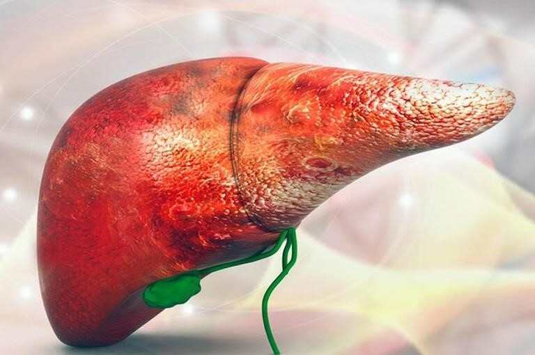 Men gan cao không nên ăn gì? Danh sách thực phẩm “đại kỵ” cần tránh