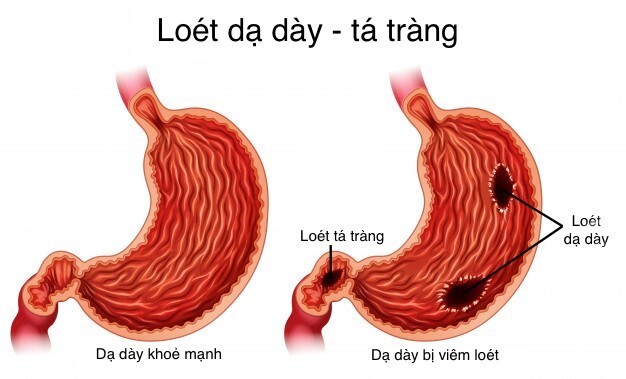 Lối sống về đêm và tác động tiêu cực đến viêm loét dạ dày tá tràng