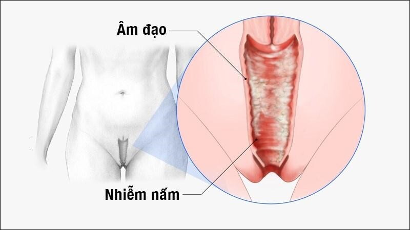 Nấm ngứa vùng kín hay tái phát và tác hại khi chủ quan