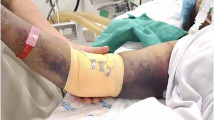 Mưa lũ, gia tăng bệnh nhân mắc sốt xuất huyết biến chứng nguy kịch