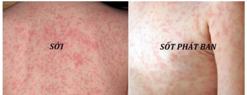 Giải đáp nhanh 9 câu hỏi thường gặp về sốt phát ban ở trẻ