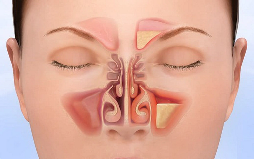 Sổ mũi xanh đặc ở người lớn: Nguyên nhân, dấu hiệu và cách điều trị
