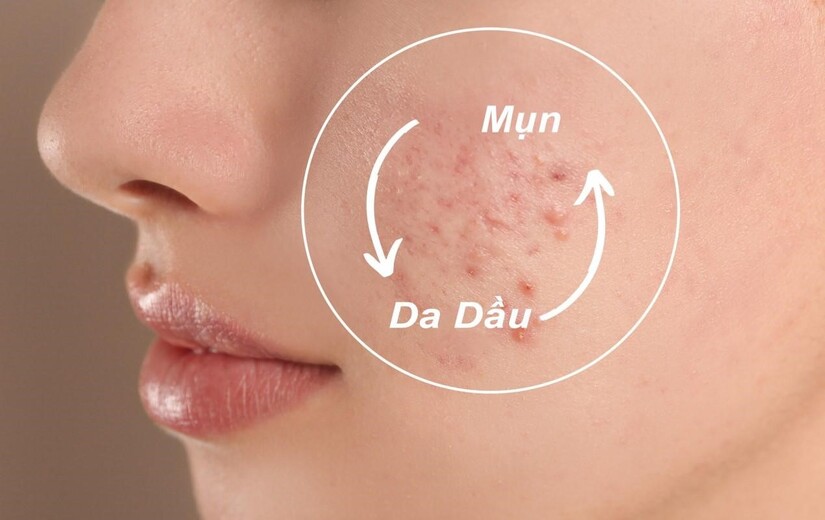 4 tiêu chí vàng giúp bạn chọn đúng sữa rửa mặt cho da dầu mụn