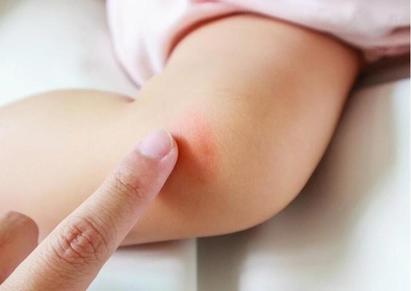 Hỏi đáp: Trẻ bị muỗi đốt bôi gì nhanh hết sưng, ngứa?