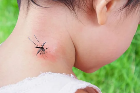Hỏi đáp: Trẻ bị muỗi đốt bôi gì nhanh hết sưng, ngứa?
