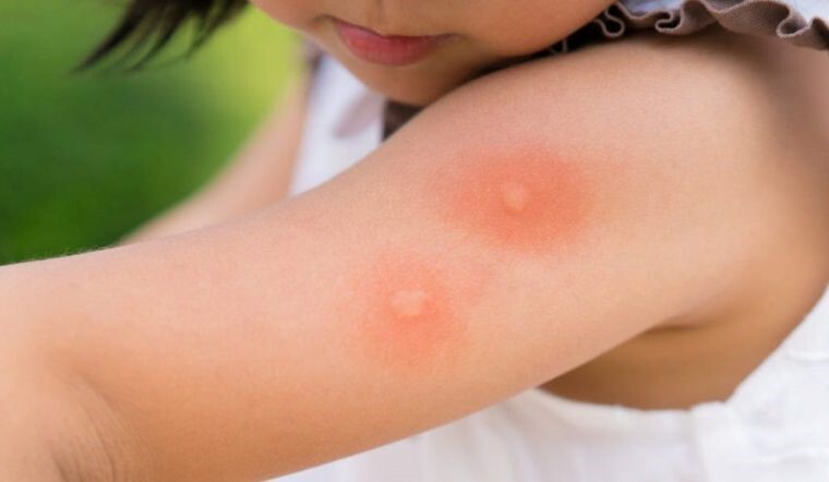 Lựa chọn xịt muỗi cho bé sao cho an toàn và hiệu quả với làn da?