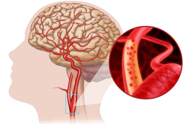 5 dấu hiệu cảnh báo máu không lên não – cần biết để phòng đột quỵ!