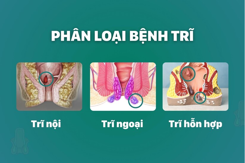 Bệnh trĩ có lây khi ngồi chung ghế không Sự thật nhiều người hiểu lầm