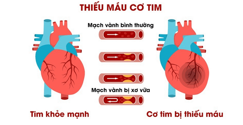 Thiếu máu cơ tim cục bộ – Khi trái tim “đói” oxy và cách khôi phục