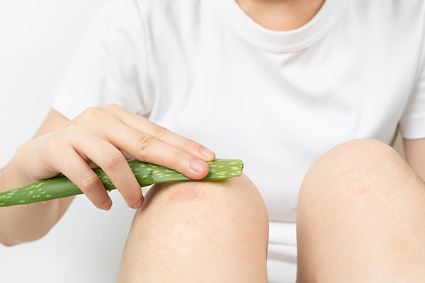 Muỗi đốt sưng to, ngứa rát: Mách mẹ 5 mẹo dân gian cực hiệu quả!