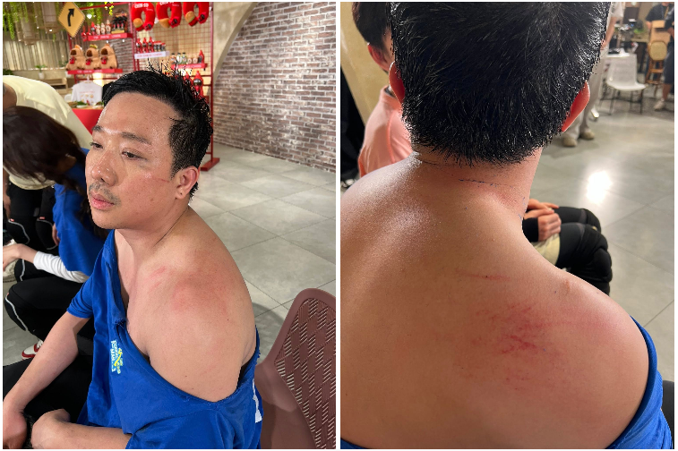 Trấn Thành đăng ảnh đầy thương tích gây lo lắng