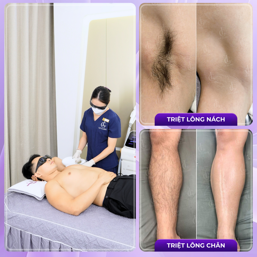 Triệt lông vĩnh viễn giá bao nhiêu? Nên triệt ở đâu uy tín tại TP.HCM?