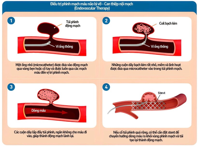Vỡ phình động mạch não: Hành trình hồi phục gian nan