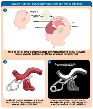 Vỡ phình động mạch não: Hành trình hồi phục gian nan