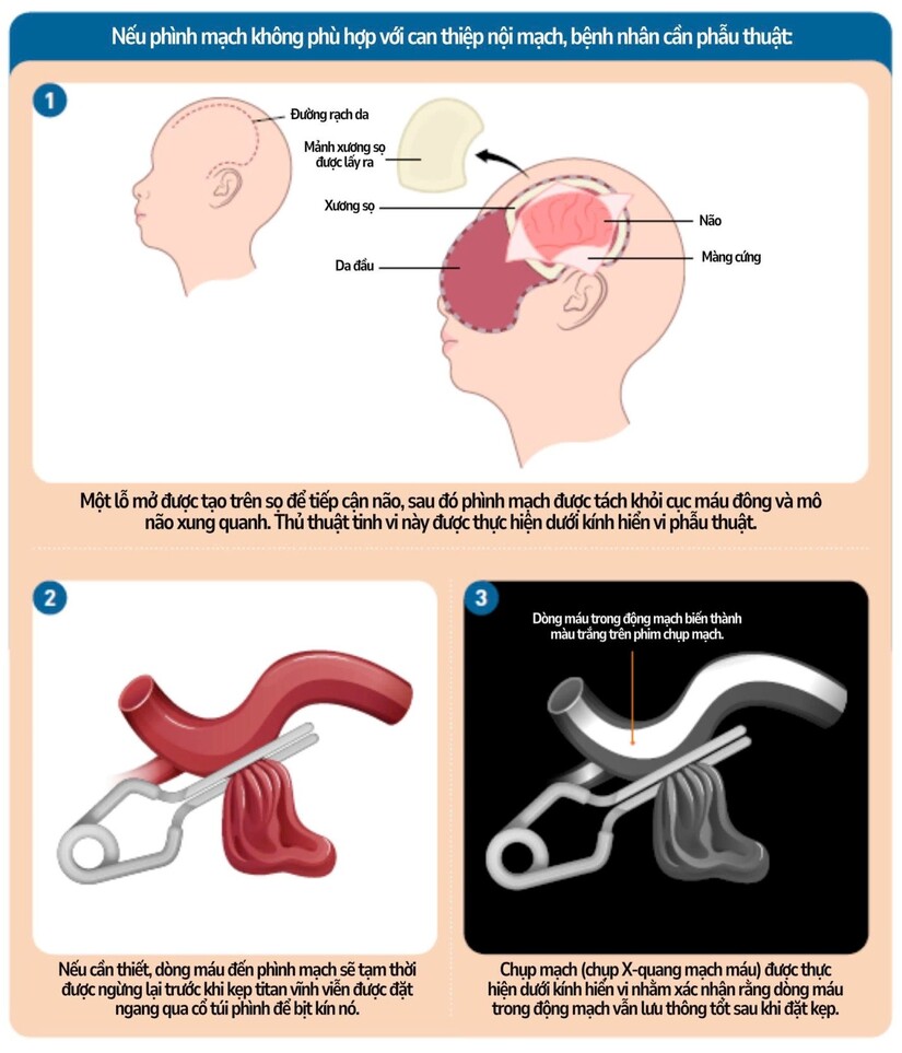 Vỡ phình động mạch não: Hành trình hồi phục gian nan
