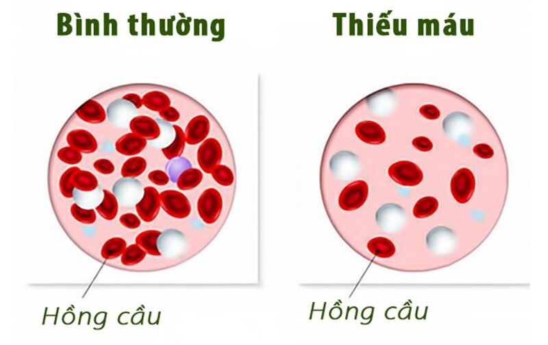 Mệt, chóng mặt, da nhợt nhạt? Cảnh báo dấu hiệu thiếu máu