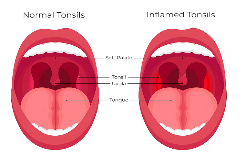 Viêm họng uống thuốc gì? Giải pháp hiệu quả giúp giảm đau rát ho khan