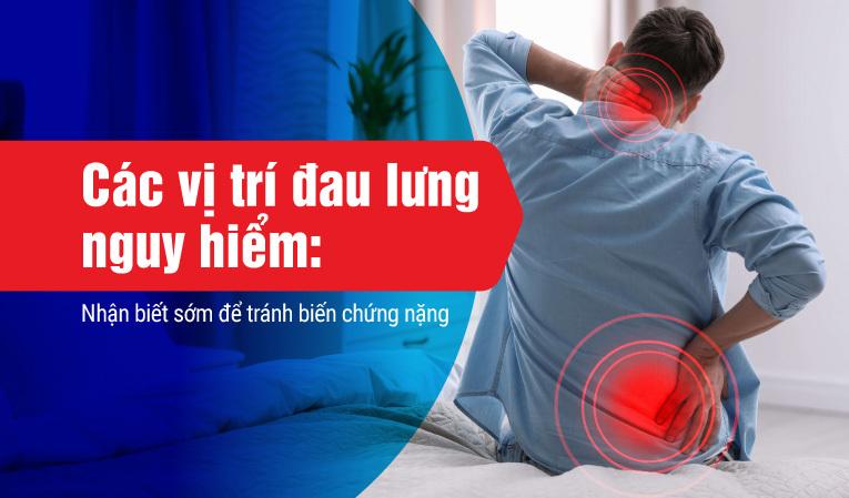 Các vị trí đau lưng nguy hiểm: Nhận biết sớm để tránh biến chứng nặng