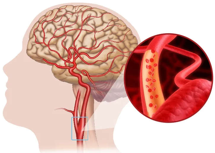 Hoạt huyết có thể hỗ trợ phòng đột quỵ không? Giải đáp chi tiết