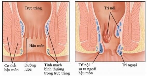 Hỏi nhanh đáp gọn: Uống thuốc gì, ăn gì tốt cho bệnh trĩ?