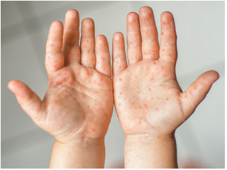 Sở Y tế TPHCM cảnh báo tác nhân EV71 xuất hiện trở lại