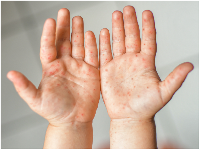 Sở Y tế TPHCM cảnh báo tác nhân EV71 xuất hiện trở lại