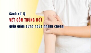 Cách xử lý vết côn trùng đốt giúp giảm sưng ngứa nhanh chóng