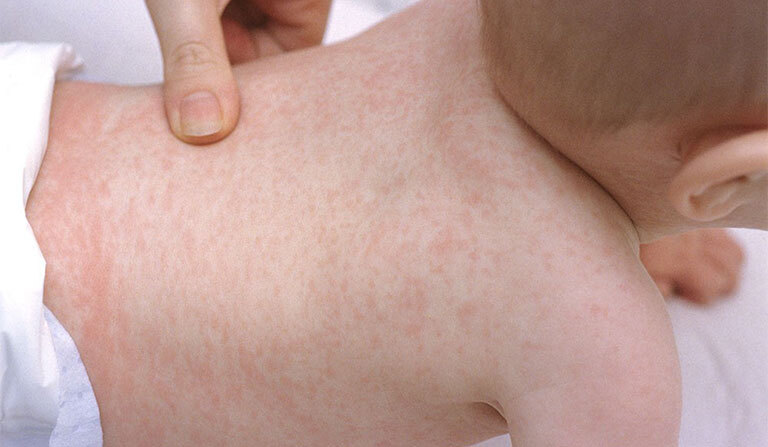 Bé bị sốt nổi mẩn đỏ: Giải đáp chi tiết, tránh hoang mang