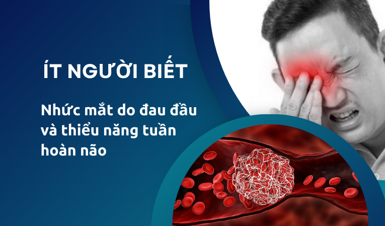 Ít người biết nhức mắt do đau đầu và thiểu năng tuần hoàn não