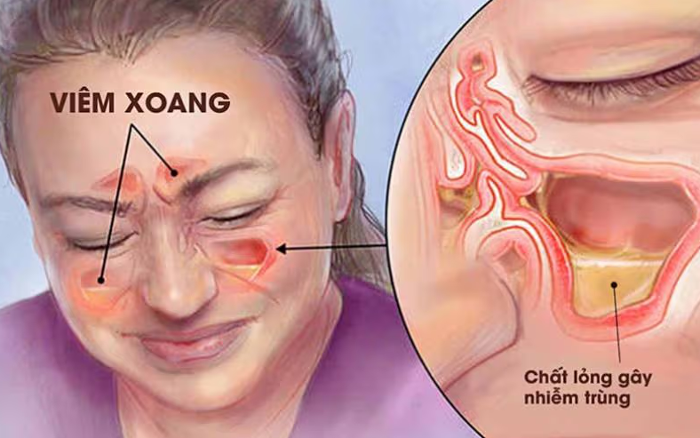 Viêm xoang gây đau đầu, đau mặt – lý do điều trị mãi không khỏi