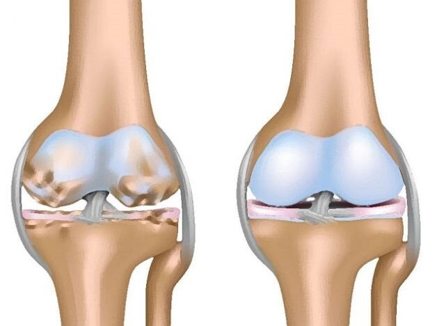 Điều trị khô khớp gối hiệu quả bằng cách bổ can thận, tăng khí huyết