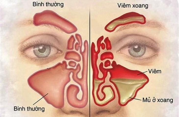 Phân tích toàn diện các loại viêm xoang và nguyên tắc điều trị