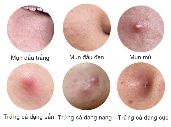 Uống kẽm trị mụn hiệu quả: cách bổ sung đúng khoa học