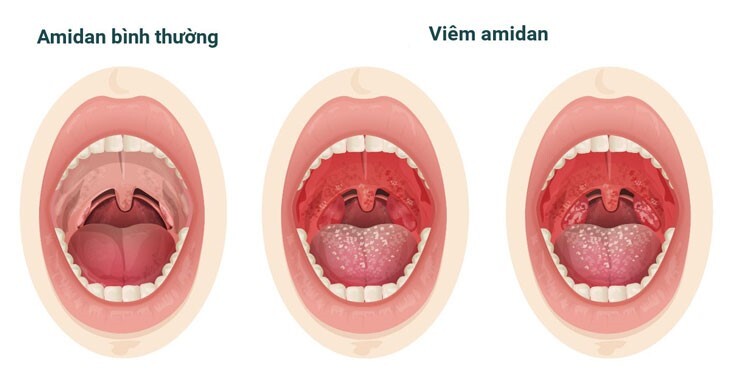 Viêm amidan ở trẻ: những dấu hiệu điển hình dễ nhận biết